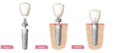 植牙和种牙的区别有什么？哪个成效比较好呢？(图5)