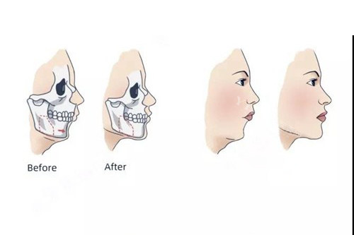 想知道自己的凸嘴怎么治？先了解有多少种畸形会导致凸嘴吧(图3)