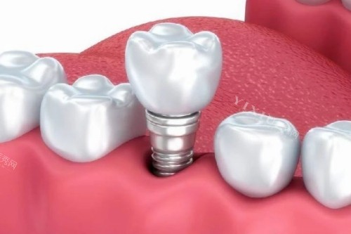 还再问苏州美奥口腔收费高吗？您想了解的牙科项目价格都在这！(图2)