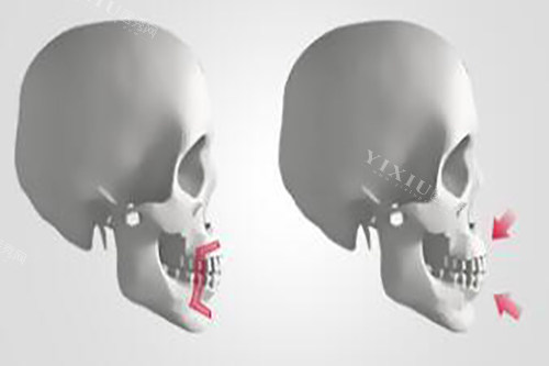 想知道自己的凸嘴怎么治？先了解有多少种畸形会导致凸嘴吧(图2)