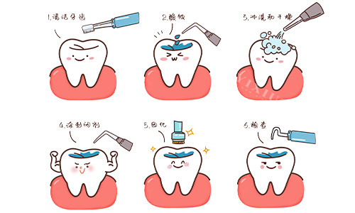 窝沟封闭步骤卡通示意图