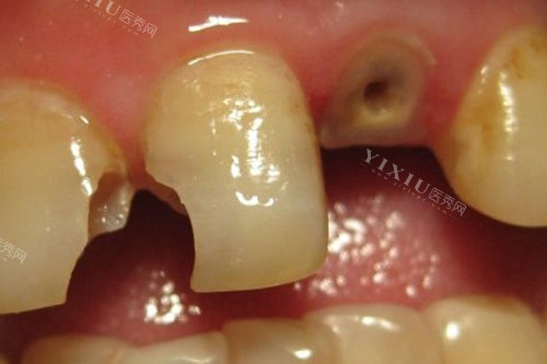 急急急!金昌补牙多少钱？后面大牙都被蛀空了怎么办？(图2)