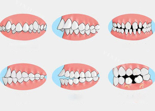 有没有阻止舌头伸前的矫正器？会下意识舔牙，怕影响整牙(图4)