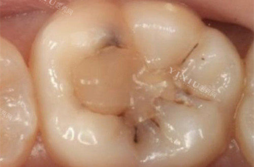补牙大概需要多少钱？据说还能走医疗保险！(图2)