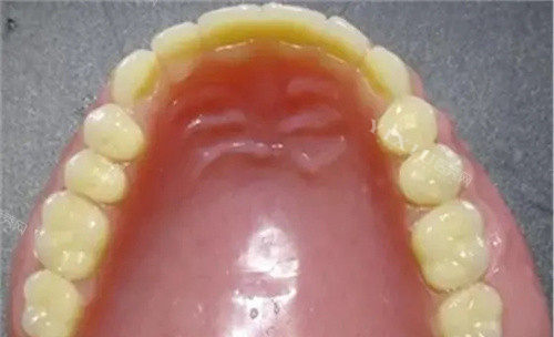 吸附假牙价格贵不贵？动辄上万元的产品优点是什么？(图4)