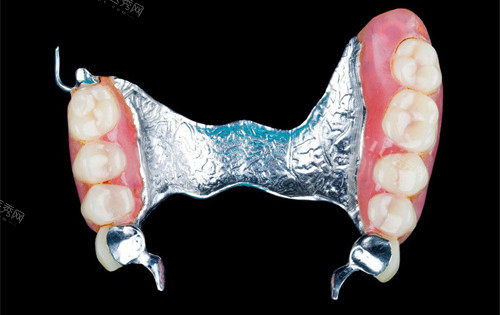 假牙知识问答：材料分类／具体价格／适合人群／进口国产等！(图4)