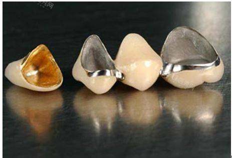 太原小店区看牙收费——口腔种植修复、口腔正畸、补牙拔牙、牙齿美白等报价参考(图3)