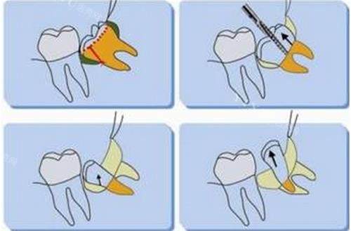 拔牙的过程