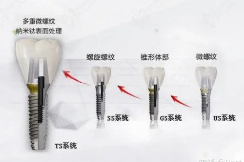 韩国奥齿泰种植牙展示图