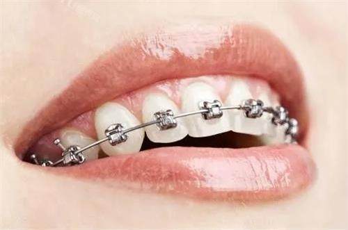 毕节牙科医院价格一览表：种植牙3500元起、牙齿矫正7798元起(图3)