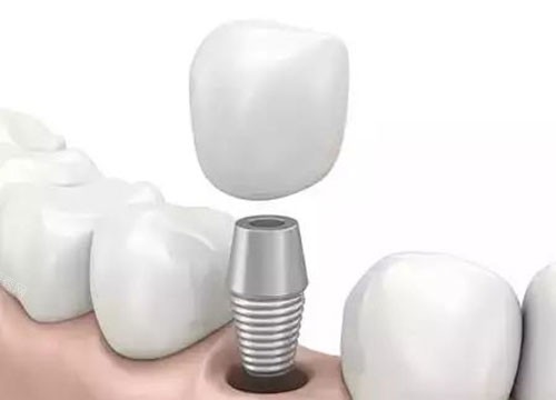 济南平阴种植牙医院排名及价格都有，多少钱一颗哪家便宜来这看(图1)