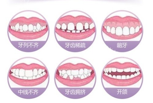 时代天使隐形矫正官网价格：标准版19800+comfos版16800+kid版15000+(图4)