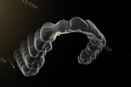 时代天使隐形矫正官网价格：标准版19800+comfos版16800+kid版15000+(图3)
