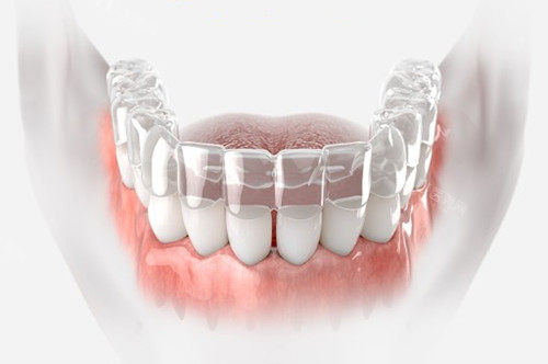 戴了隐形牙套不能不知道的几件事：不咬胶的危害首当其冲(图3)