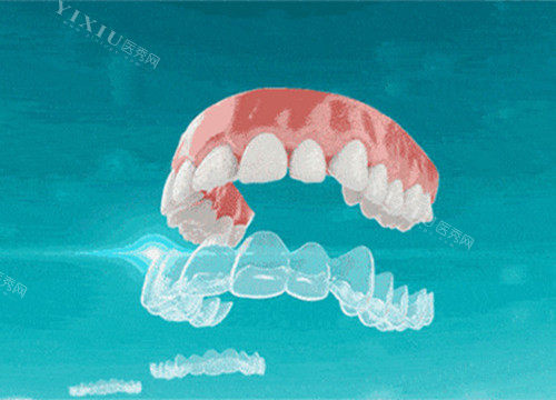 隐形矫正模型示意图