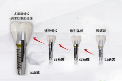 韩国奥齿泰种植牙展示图