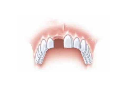 欧美种植体太贵没法下手？那来看看文内的韩国植体优缺点介绍看能不能种草！(图2)