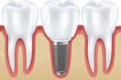 欧美种植体太贵没法下手？那来看看文内的韩国植体优缺点介绍看能不能种草！(图3)