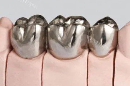 大胆预测一下2024年的牙冠价格！烤瓷牙／国产全瓷牙／进口全瓷牙收费标准都有！(图3)