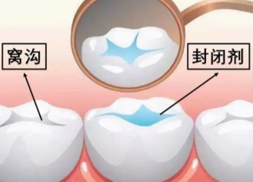 儿童几岁做牙齿窝沟封闭比较好?3岁算早吗?
