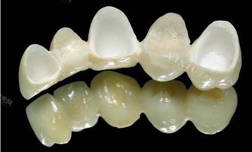 抄作文喽！北京牙冠价格2024来袭，烤瓷牙冠880+全瓷牙冠国产1200+进口2000+(图3)