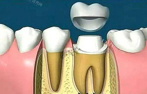 抄作文喽！北京牙冠价格2024来袭，烤瓷牙冠880+全瓷牙冠国产1200+进口2000+(图1)