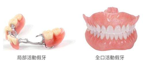 局部活动假牙和全口活动假牙的对比