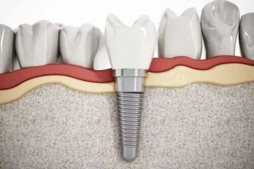 不用麻烦！美国皓圣植体的超详细介绍帮助您更好地选择想要的种牙品牌！(图2)