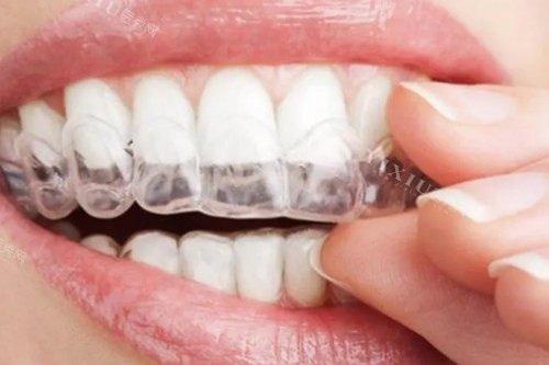 您知道吗其实隐适美有六个不同的版本！文内为您详细介绍儿童版／青少年版／极速版／经典版等！(图1)