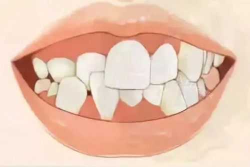 牙齿畸形