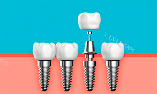 楚雄种植牙哪家医院好？排名榜单中奥德、爱牙、伍鹏口腔有技术又便宜(图3)