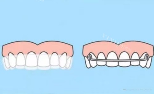 听牙医来解答：隐形牙套到底靠什么来移动牙齿？(图1)