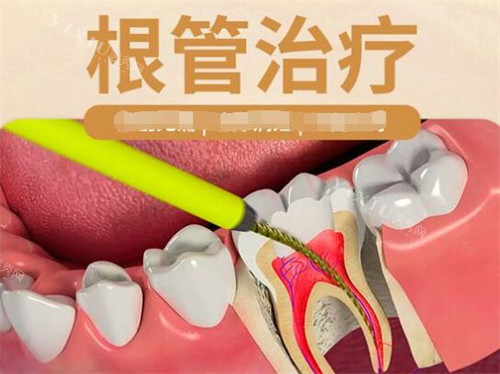 佛山好佰年口腔根管治疗
