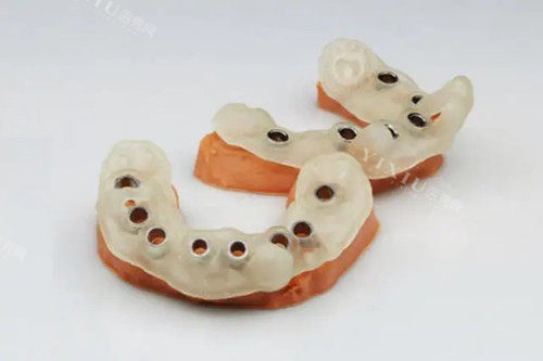 种植牙导板模型示意图