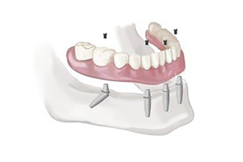 选登腾还是奥齿泰？种植牙的技术与难度评估，带你看清更佳方案(图3)