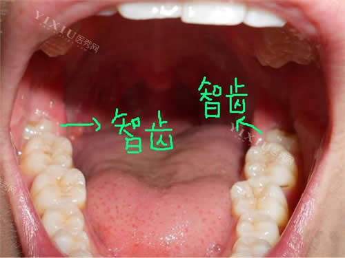口腔下智齿位置介绍