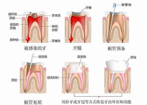 牙齿根管治疗流程卡通图