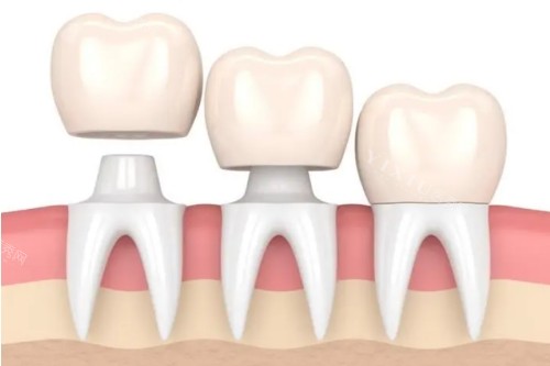 康贝佳口腔医院价格表更新：大家关注的种牙到洁牙项目都在这里！(图2)