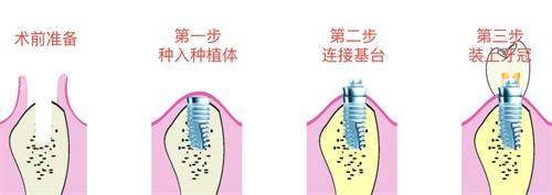 放心选择：赤峰种植牙医院哪家好？公布一份赤峰种植牙口碑好的牙科医院排行(图6)