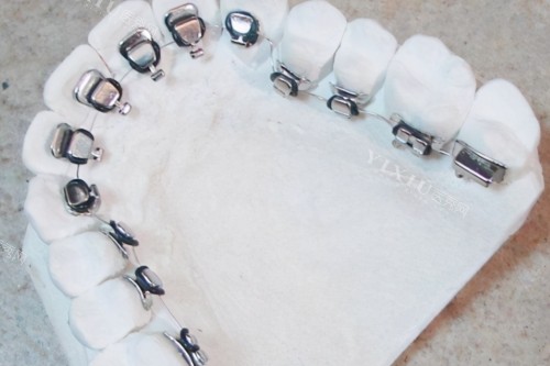 正畸3年了缝还收不完怎么办？别急，看口腔医生为你解惑！(图3)