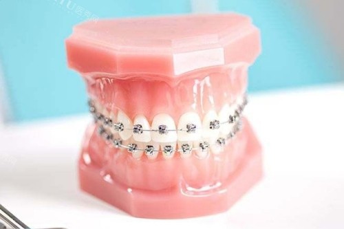 正畸3年了缝还收不完怎么办？别急，看口腔医生为你解惑！(图2)