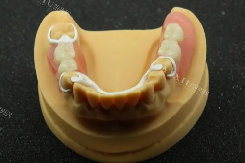 peek义齿支架模型图