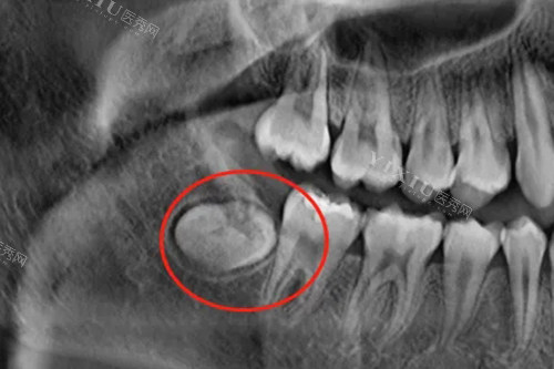 智齿磨平比较好还是拔掉呢？进来看看牙医怎么说吧~(图2)