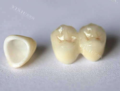 牙齿根管治疗佩戴牙冠展示