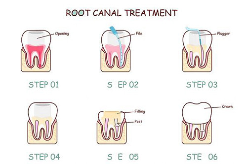 牙齿根管治疗过程