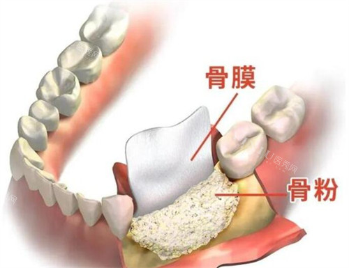 植牙骨粉骨膜材料图展示