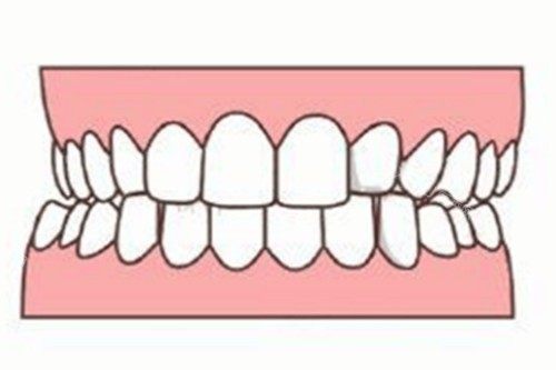 有网友提问说隐适美矫正的费用是一次性付清的吗？下面和各位深入探讨一下！(图1)