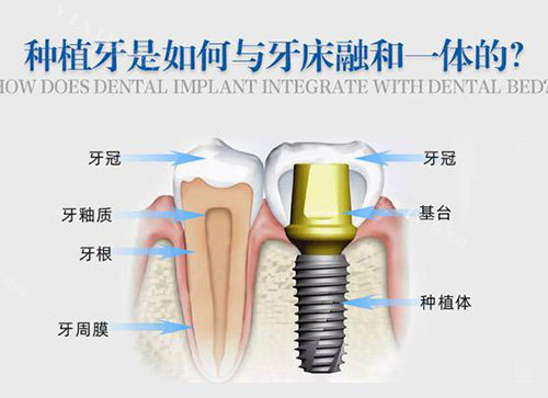 种植牙和牙床关系图展示