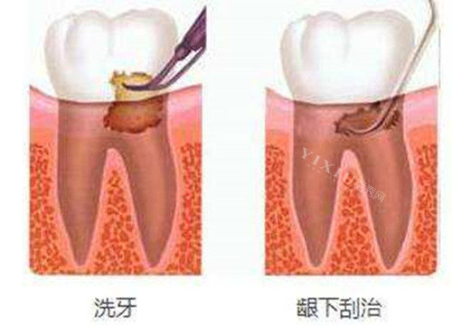 洗牙和龈下刮治对比示意图