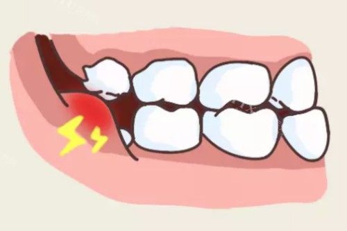 智齿导致牙龈肿胀卡通图